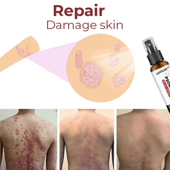 Last day 80% off 🔥LOVILDS™PsoriaHeal psoriasis Treatment Spray pro