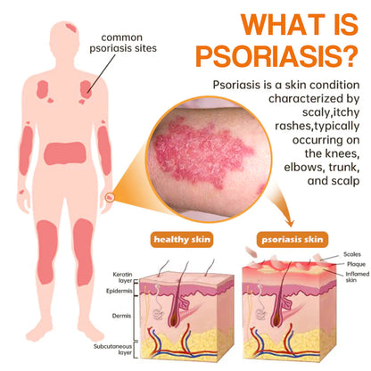 Last day 80% off 🔥LOVILDS™PsoriaHeal psoriasis Treatment Spray pro