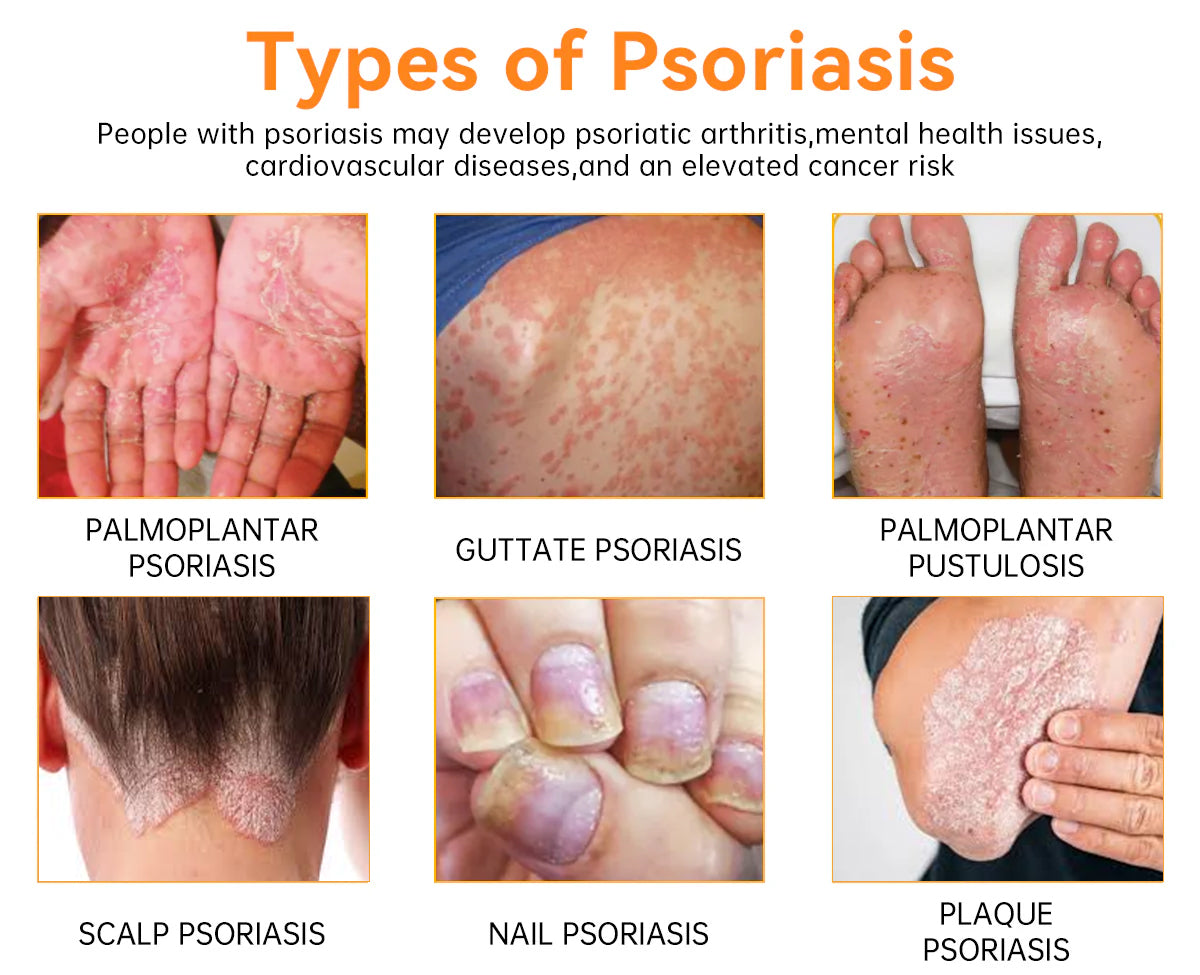 Last day 80% off 🔥LOVILDS™PsoriaHeal psoriasis Treatment Spray pro