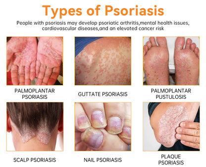 Last day 80% off 🔥LOVILDS™PsoriaHeal psoriasis Treatment Spray pro