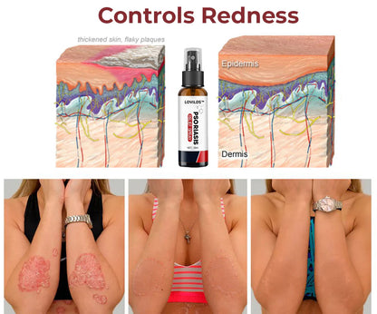 Last day 80% off 🔥LOVILDS™PsoriaHeal psoriasis Treatment Spray pro