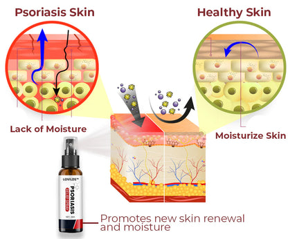 Last day 80% off 🔥LOVILDS™PsoriaHeal psoriasis Treatment Spray pro
