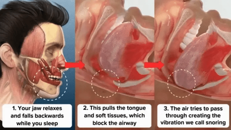ALISANDA PerfectSleep Solution – Snore-Reducing & Teeth-Grinding Guard image ALISANDA PerfectSleep Solution – Snore-Reducing & Teeth-Grinding Guard